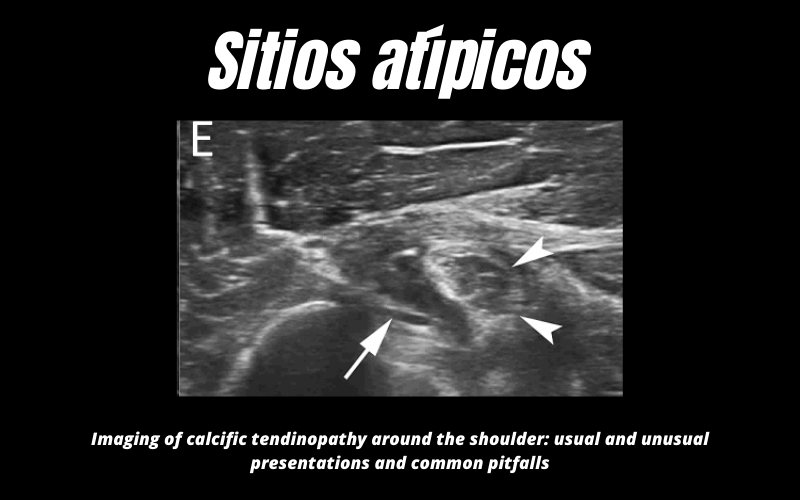 Sitio Atipico Calcificacion Ecografia 9.png